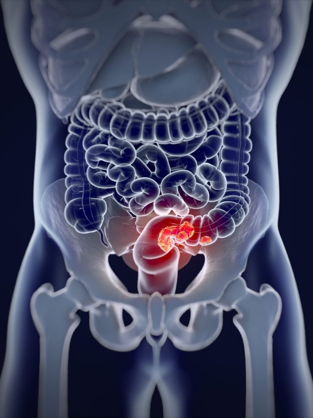 Myth and Fact about Colorectal Cancer