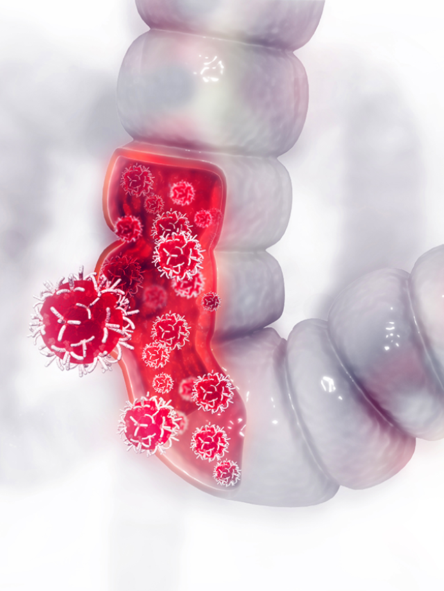 What is Colon Cancer, and what are its symptoms?